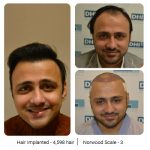 Best Hair Transplant Clinic In Chandīgarh