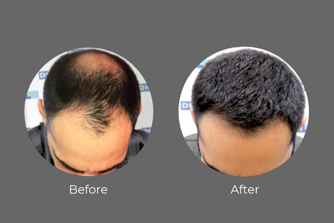 Hair transplant in India Hair transplant in India