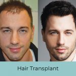 Best Hair Transplant Clinic in Delhi