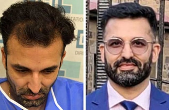 1 before-after-hair-transplant