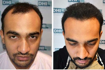 2 before-after-hair-transplant