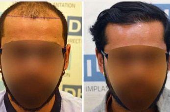 3 before-after-hair-transplant