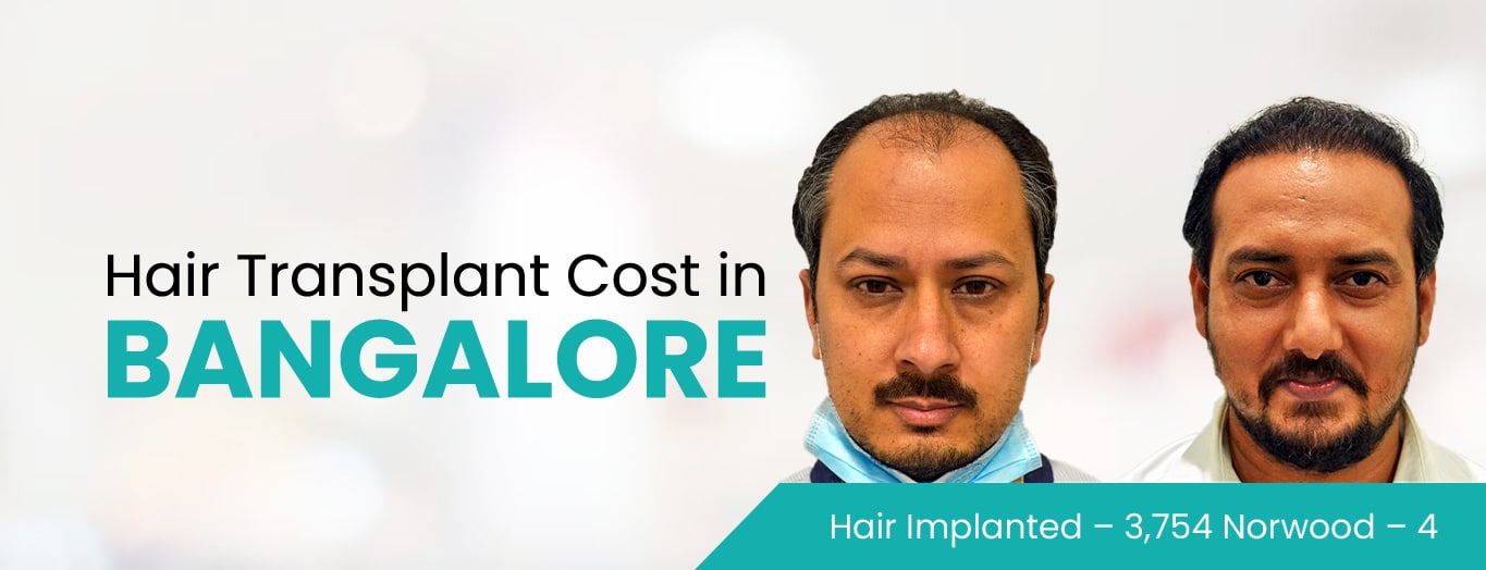 dhi-web-bnr Hair Transplant Cost in Bangalore India