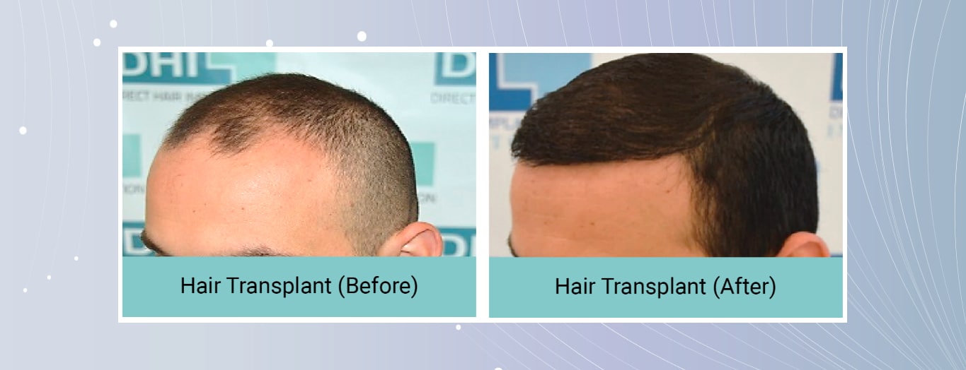 Hair Transplantation for Temporal Hair Loss Hair Transplantation for Temporal Hair Loss