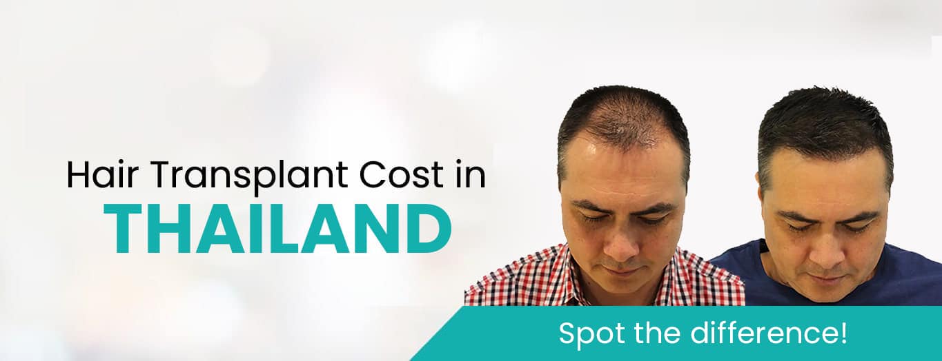 Hair Transplant in Thailand