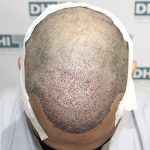 Cost of hair transplant procedure