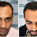 hair transplant treatment in Mexico
