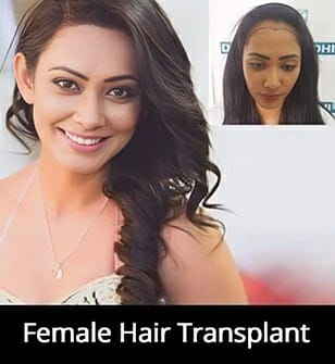 imageedit_12_4180201360_1 Female Hair Transplant