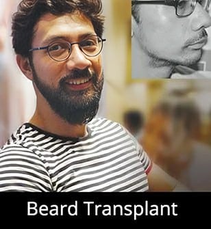 imageedit_4_8687719392_1 Beard Transplant