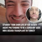 Why India is the Premier Destination for Hair Transplant Treatment?