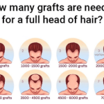 hair transplant