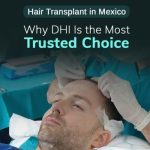 Hair Transplant in Mexico