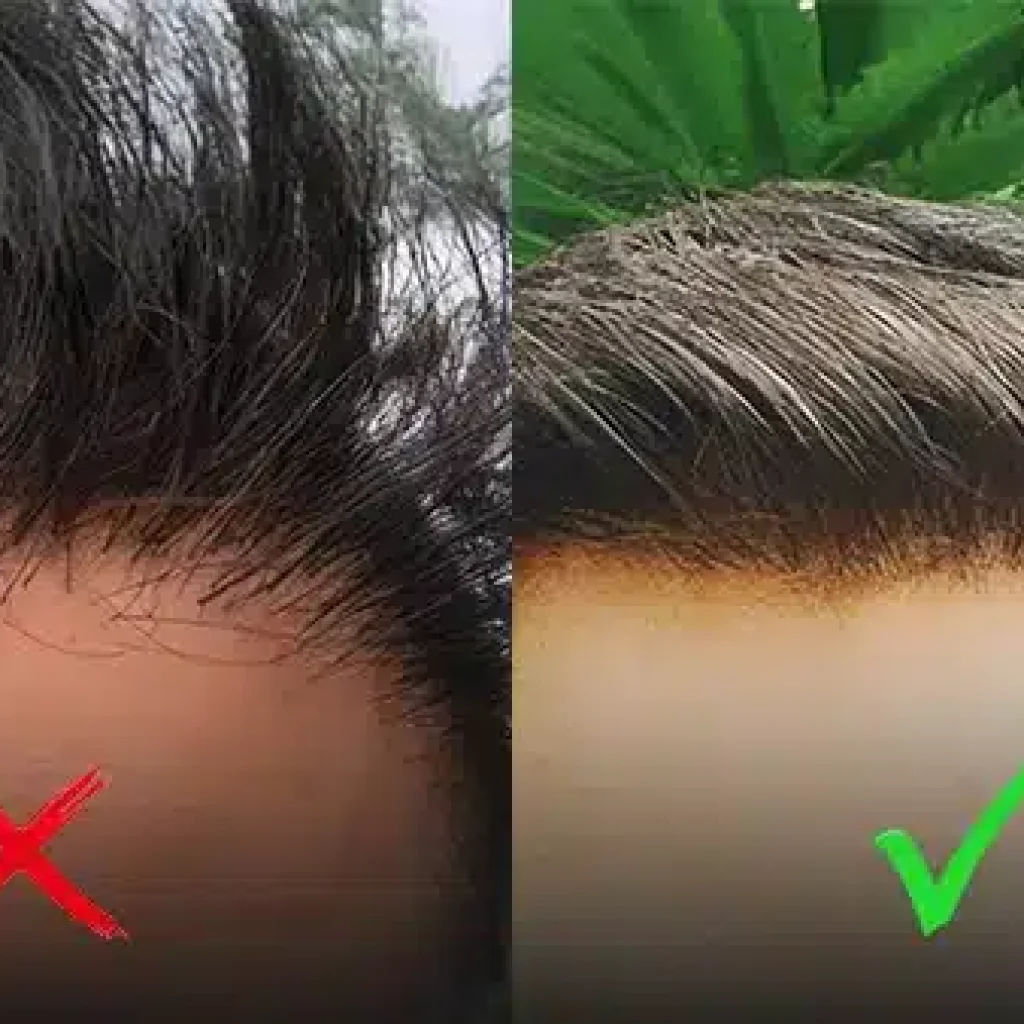 Hair Transplant and Direct Hair Implantation: What You Need to Know